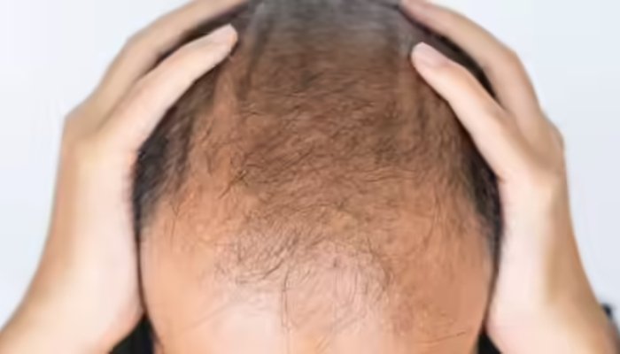 صرف 20 دن میں نئے بال، نئی ریسرچ نےگنج پن کے شکار افراد کیلئے نئی امید پیدا کردی